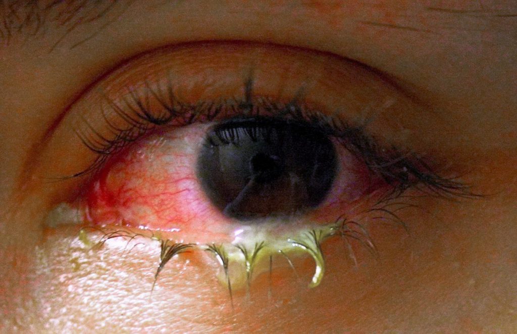 swollen-eye-with-conjuntivitis